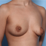 Breast Lift with Implant Before & After Patient #34302